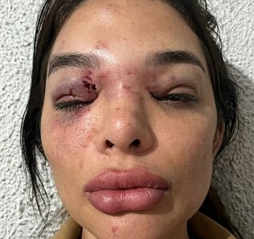 Mulher fica deformada após ser espancada por marido; empresário é preso em flagrante 