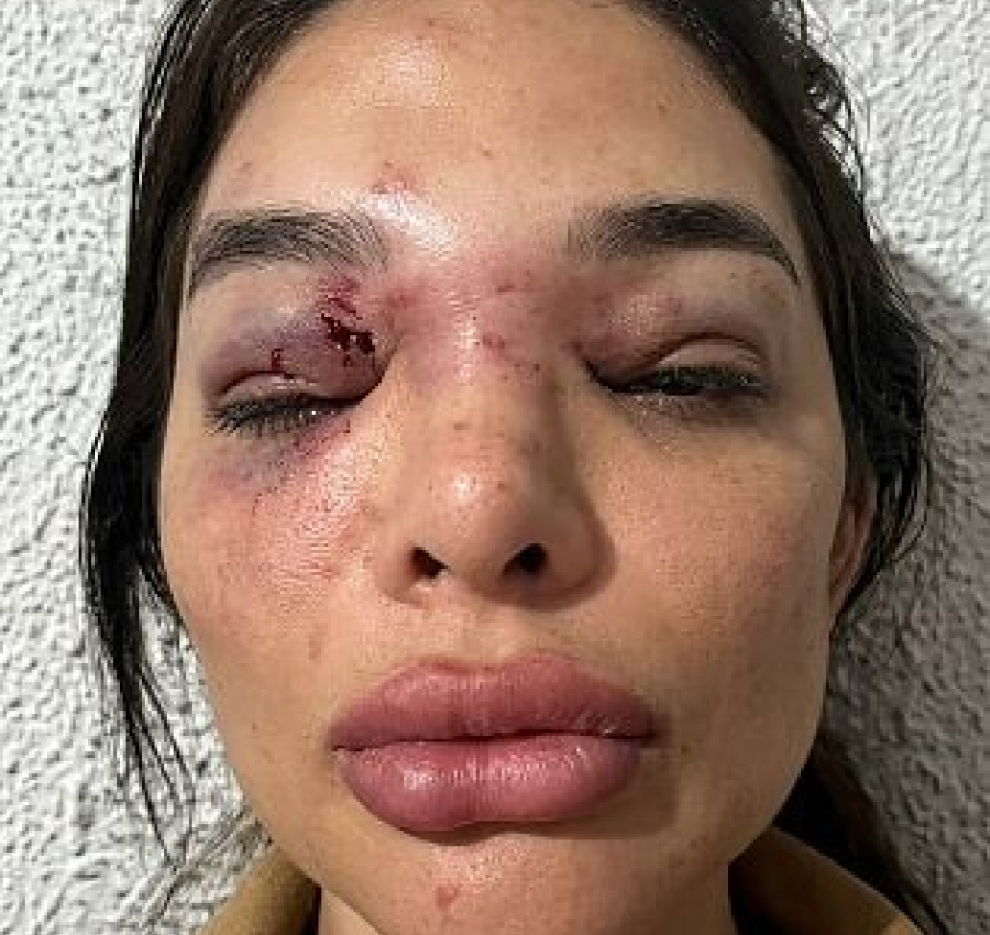 Mulher fica deformada após ser espancada por marido; empresário é preso em flagrante 