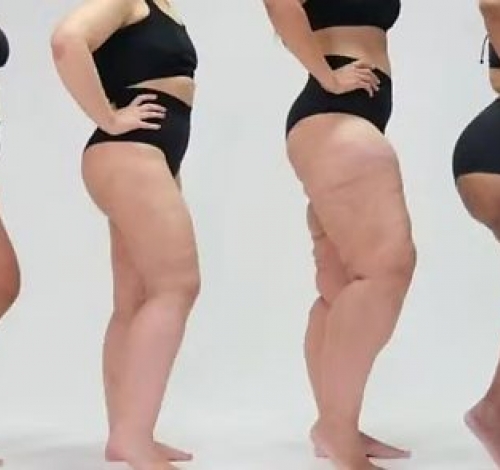 Lipedema afeta milhões de mulheres e ainda é confundido com obesidade e celulite