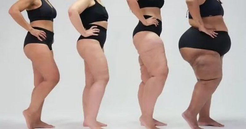 Lipedema afeta milhões de mulheres e ainda é confundido com obesidade e celulite