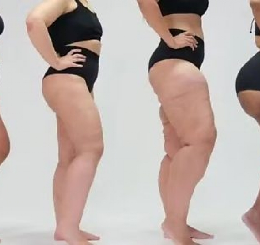 Lipedema afeta milhões de mulheres e ainda é confundido com obesidade e celulite